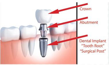 Cost of Abutments and Crowns in Dental Implants