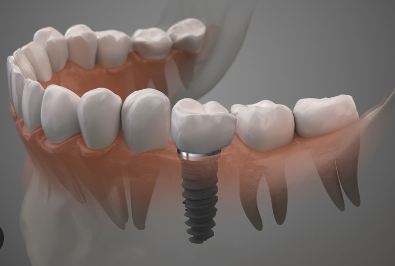 Cost of Dental Implants in Minnesota