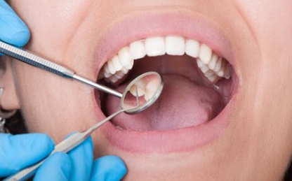 Dental Bonding Cost in Atlanta