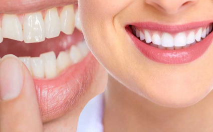 Dental Bonding Cost in Bangalore