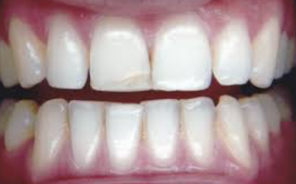 Dental Bonding Cost in Hyderabad