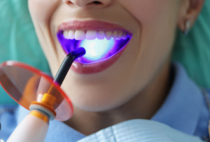 Dental Bonding Cost in Montreal