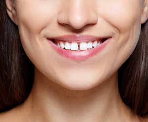 Dental Bonding Cost in Nepal