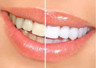 Dental Bonding Cost in Pune