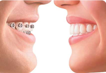 Dental Braces Cost in Chennai