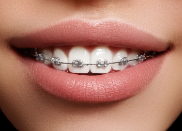 Dental Braces Cost in Kenya