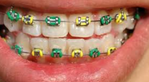 Dental Braces cost in Bangladesh