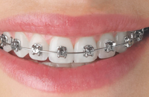 Dental Braces cost in Pakistan: