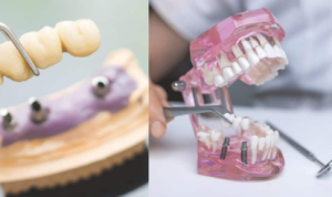 Dental Bridge Cost in Islamabad