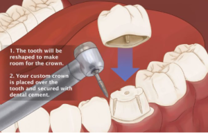 Dental Bridge Cost in Taiwan