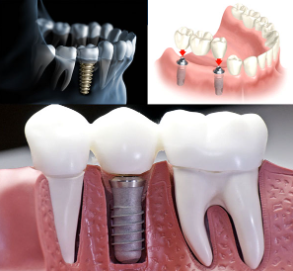 Dental Implants Cost in Islamabad