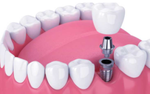 Dental Implants Cost in Trivandrum