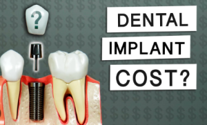 Dental Implants in Bali Cost