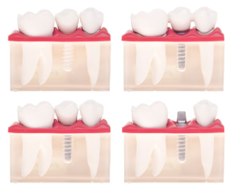 Tooth Implant Cost in Kuching