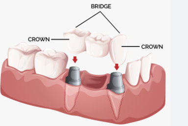 fix bridge teeth price in taiwan