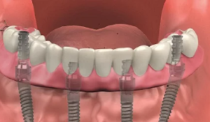 cost of complete set of dental implants