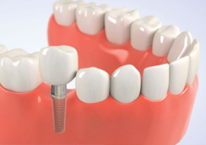 Cost of Dental Implants in Michigan