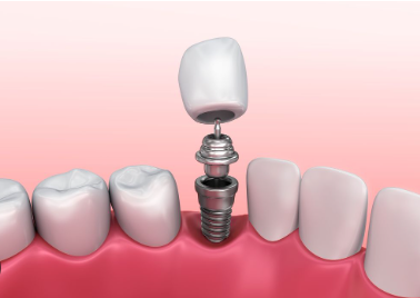 cost of dental implants in mississippi