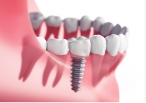 cost of dental implants in nova scotia