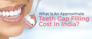 dental bonding for gaps cost in india