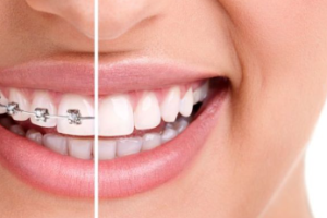 dental braces cost in hyderabad