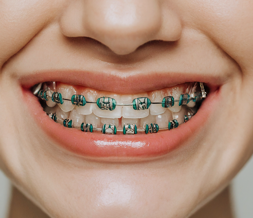 dental braces cost in mumbai