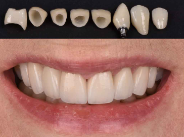 dental crown cost in dubai