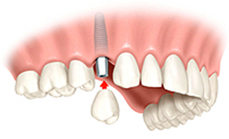 dental crown cost in saudi arabia