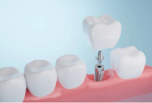 dental implants cost in saudi arabia