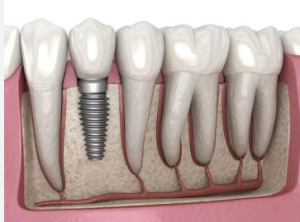 straumann dental implants price in india