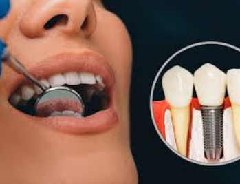 tooth implant cost hungary