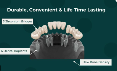 3 on 6 Dental Implants Cost