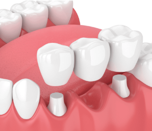 3 tooth implant bridge cost