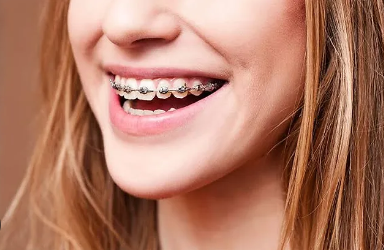 Dental Braces Cost in PGI Chandigarh