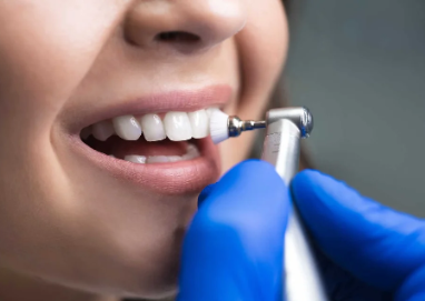 Dental Cleaning Costs in Alberta