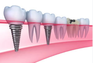 Dental Implant Cost in Kottayam