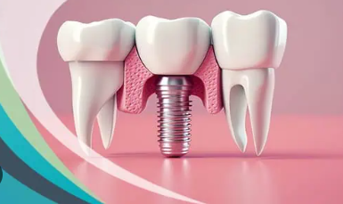 Dental Implant Cost in Kozhikode