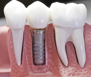 Dental Implant Cost in Thrissur