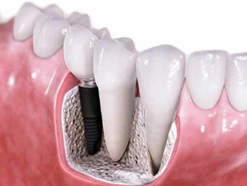 Dental Implant Costs in Ernakulam