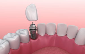 Dental Implants cost in Albuquerque