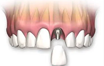 Dental Implants cost in Malappuram