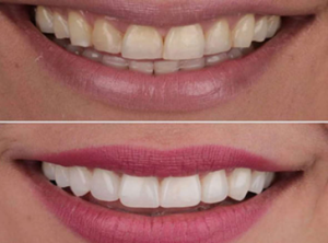 Dental Veneers Cost in India