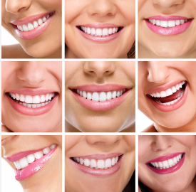 Dental Veneers Cost in Kerala