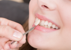 Dental Veneers cost in Chennai