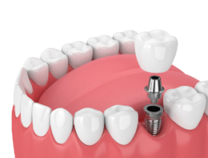 Full Mouth Dental Implants Cost cheapest