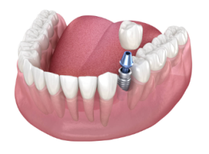 Government Grants for Dental Implants in Australia