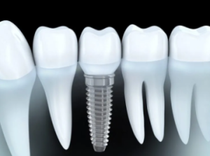 KGMU Dental Implant Cost