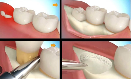 KTPH wisdom tooth extraction cost