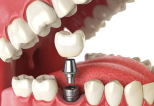 Mini Dental Implants cost