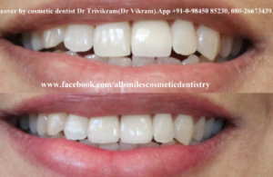 Smile Makeover Cost in Bangalore